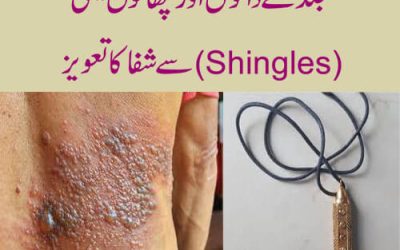 جلد کے دانوں اور چھالوں یعنی(Shingles)سے شفا کا تعویز