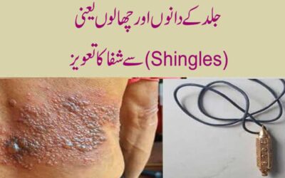 Jild Ke Danon (Shingles) Se Shifa Ka Taweez